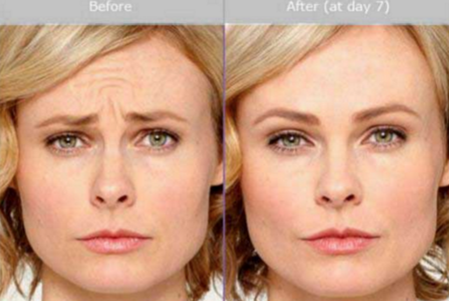 Botox How It Damages Us! — Steemit